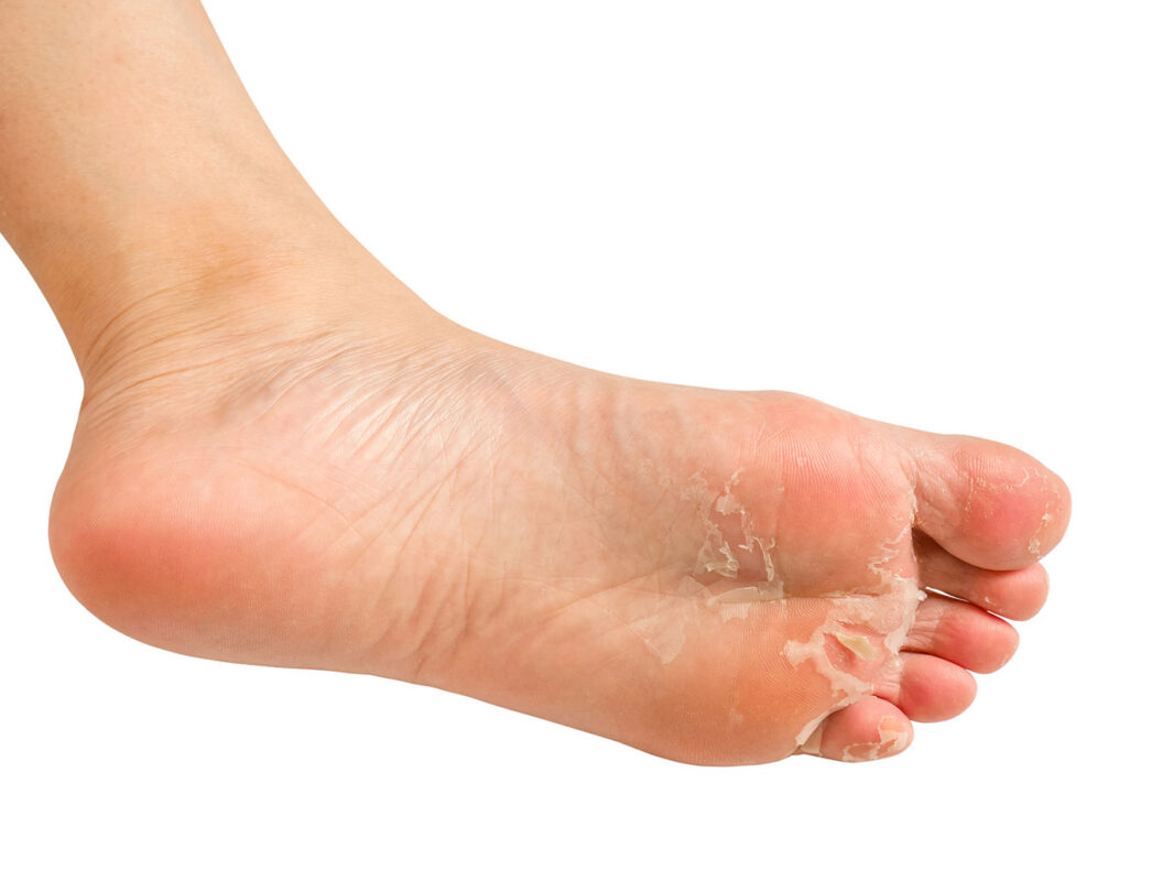 athlete's foot treatment