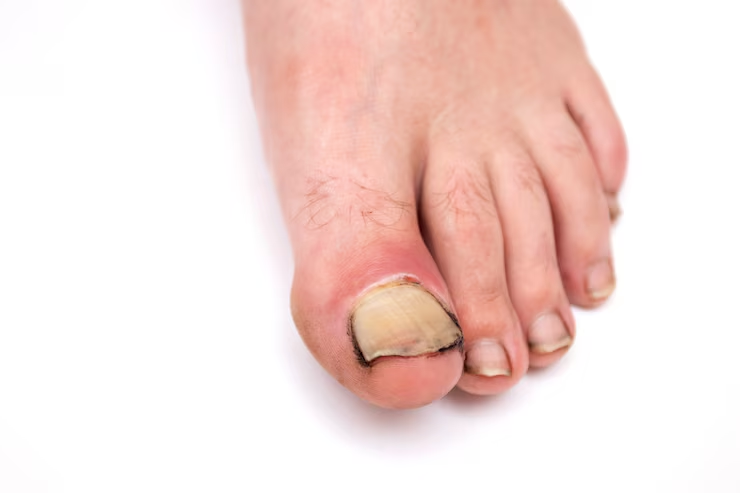Toenail Fungus