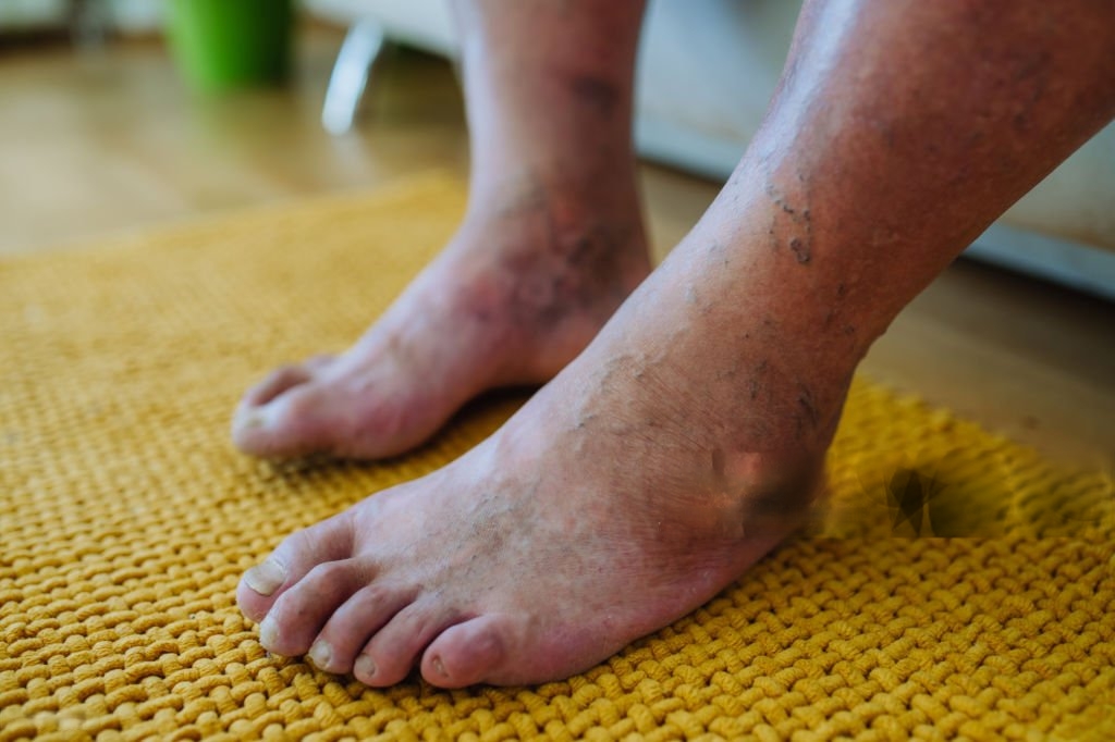 Diabetic Foot Care