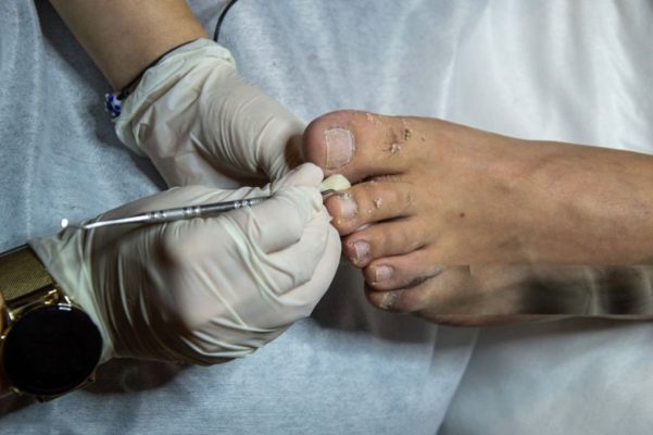 Close up Ingrown Toenails