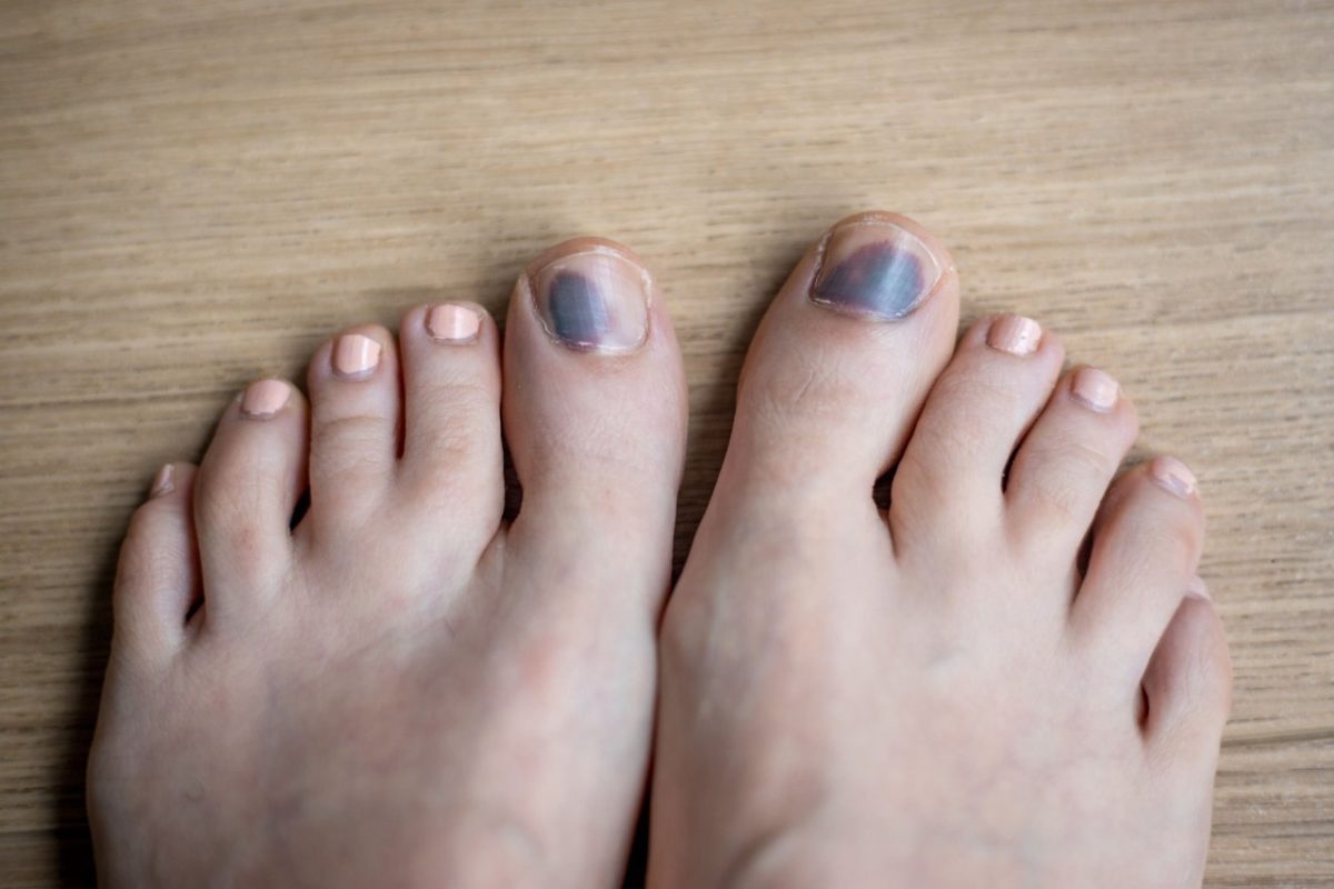 Toenail Discolouration