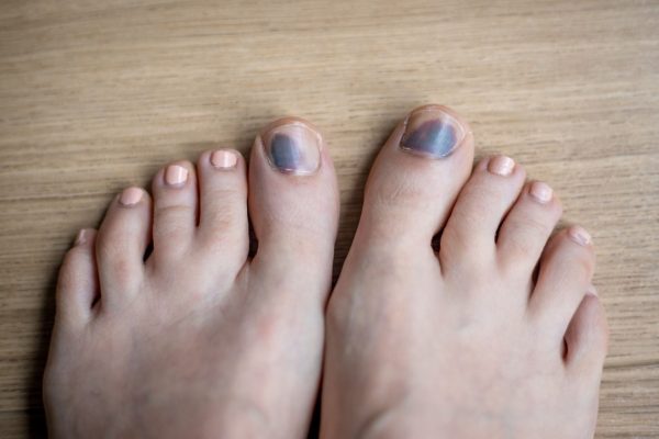 Toenail Discolouration